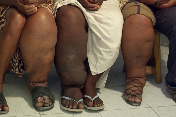  Penyakit kaki gajah (filariasis). (Foto: dinkes.inhukab.go.id)