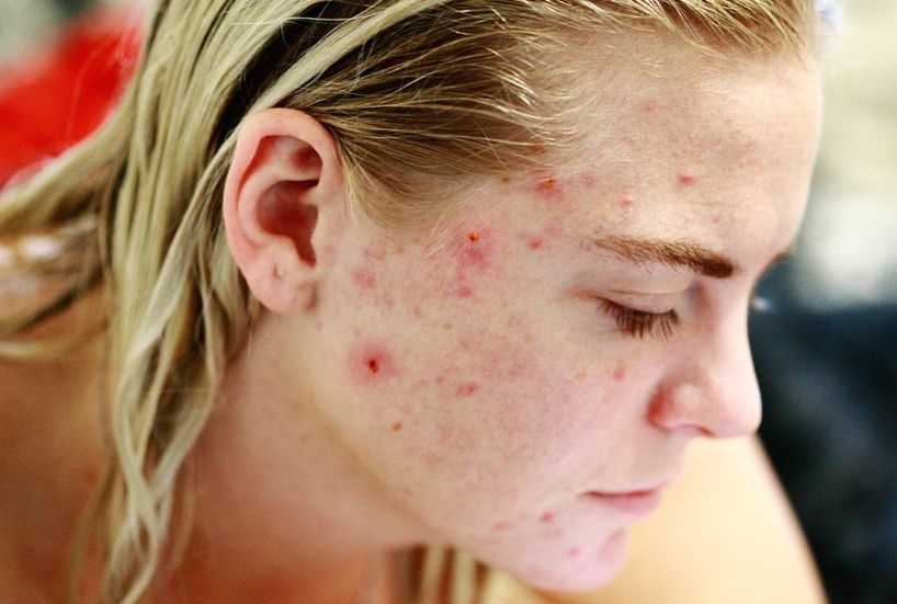 Jerawat perempuan (Pixabay).