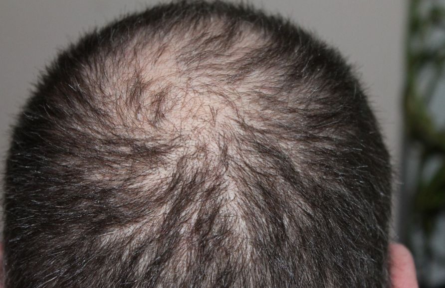 Rambut rontok (Pixabay).