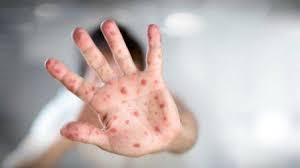 Ilustrasi Cacar Monyet (Monkeypox). Sumber: Indonesia.go.id