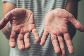 Ilustrasi Cacar Monyet. Sumber Foto: grid.id